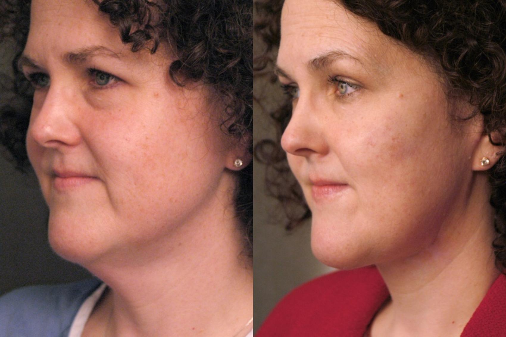Before & After Naturalift™ Mini Facelift Case 78 View #1 View in New York, NY