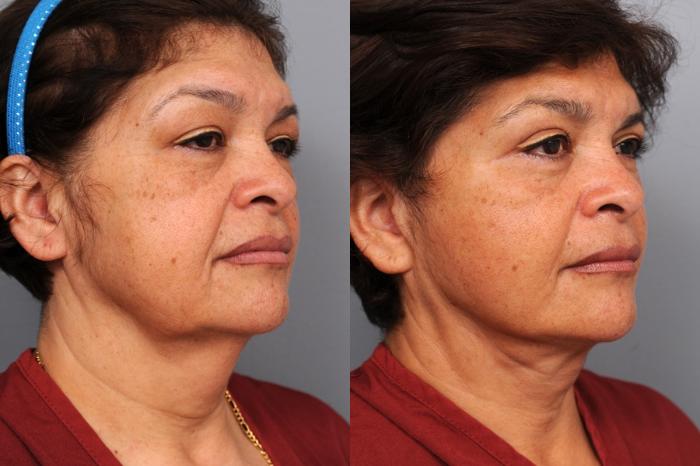 Before & After Naturalift™ Mini Facelift Case 79 View #4 View in New York, NY