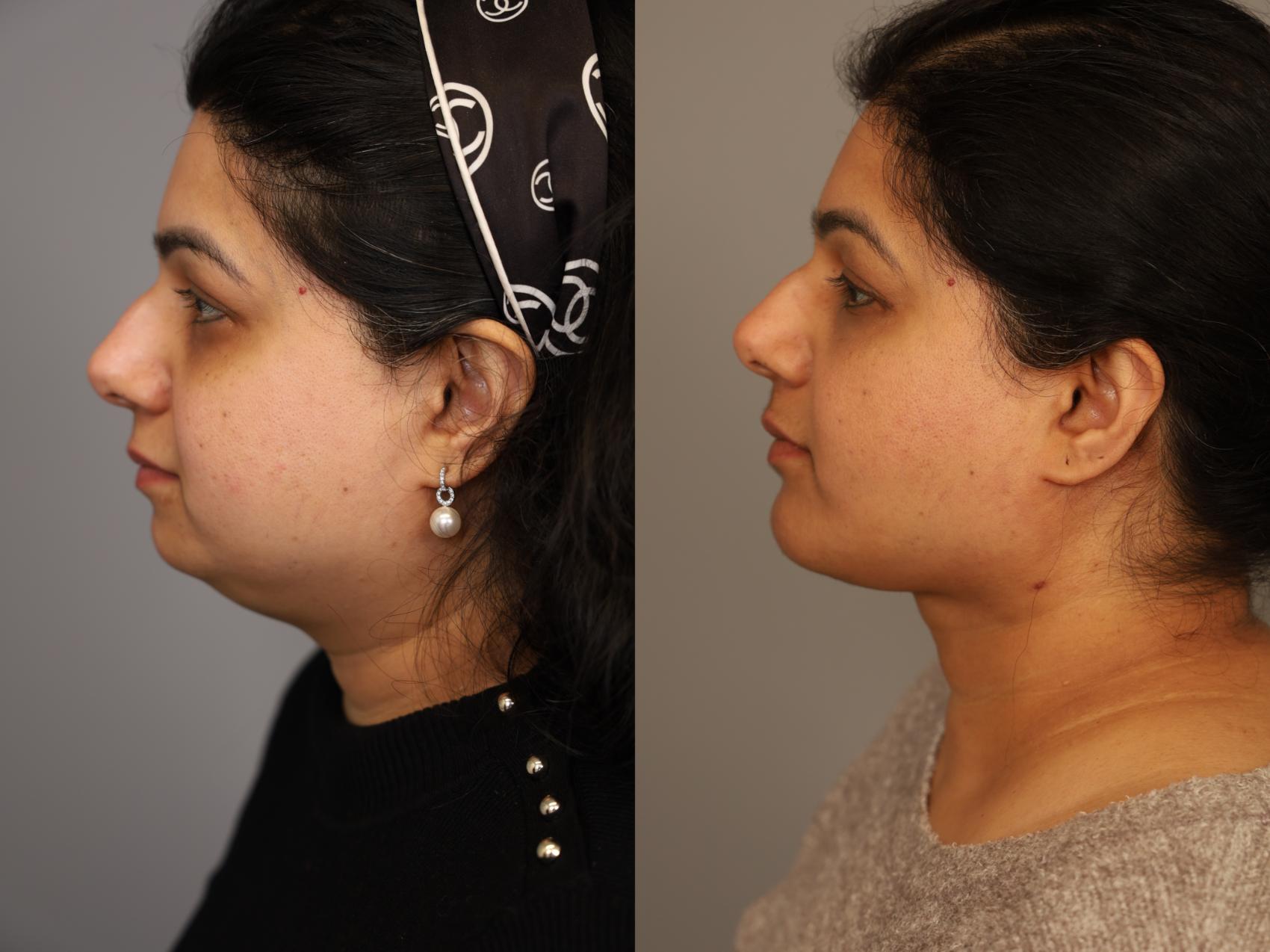 Before & After Mini Neck Lift (Single Incision) Case 293 Right Side View in New York, NY