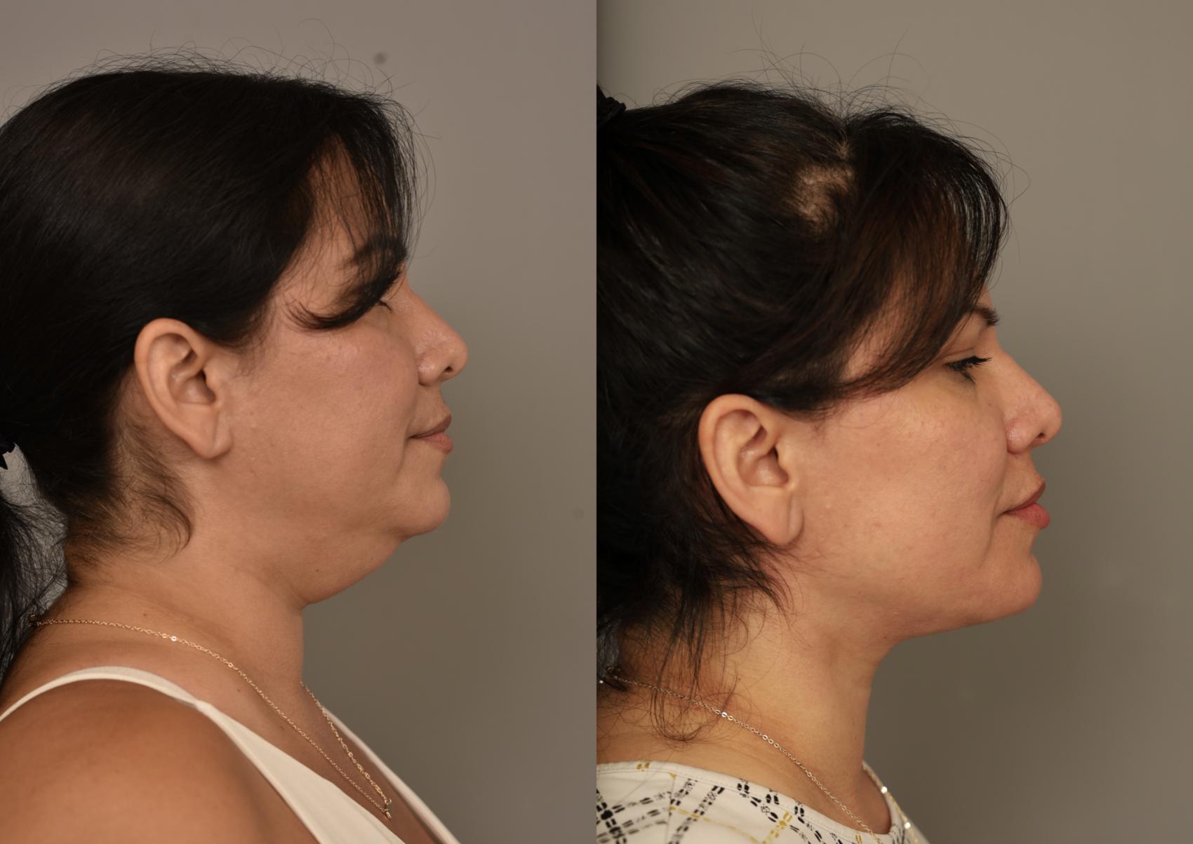 Formal Neck Lift