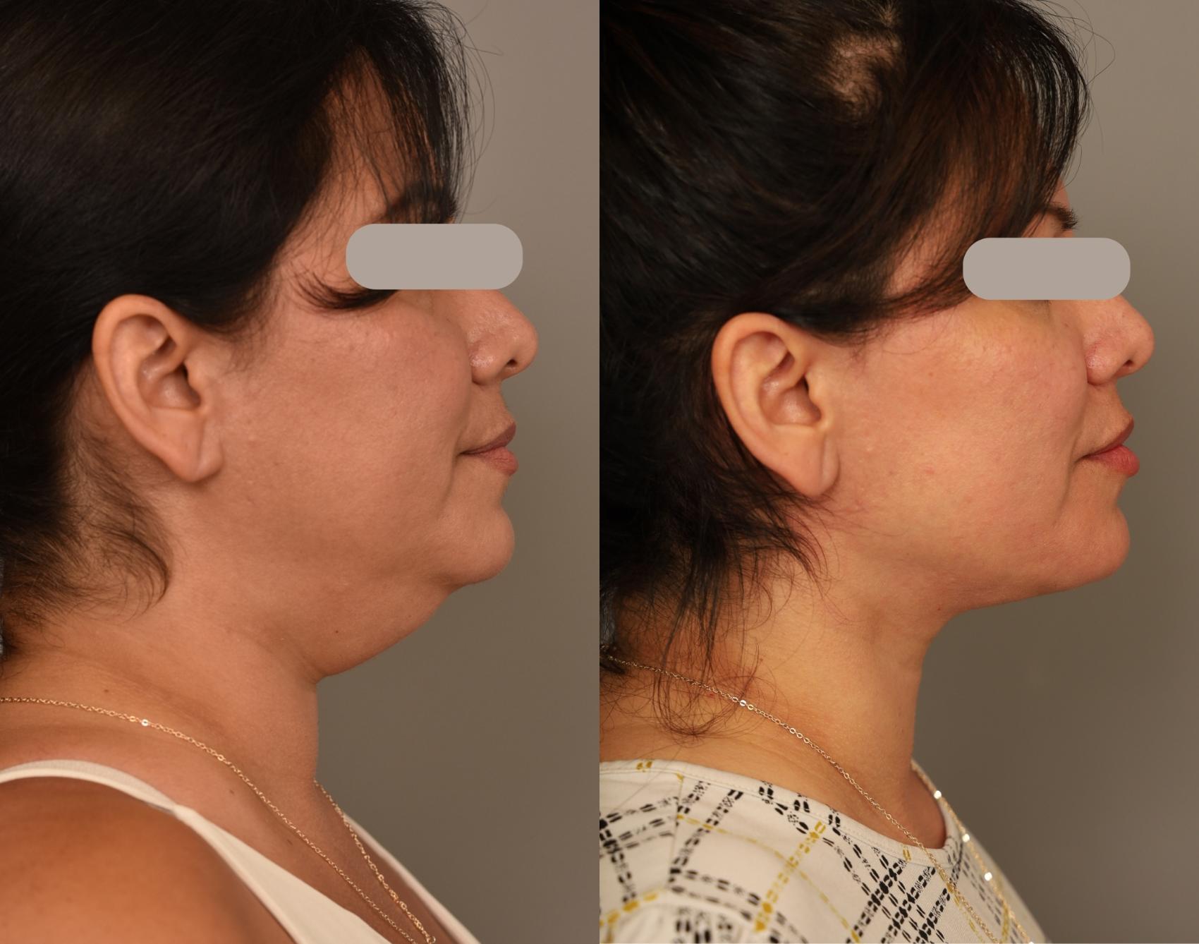 Before & After Neck Lift (Traditional) Case 305 Left Side View in New York, NY