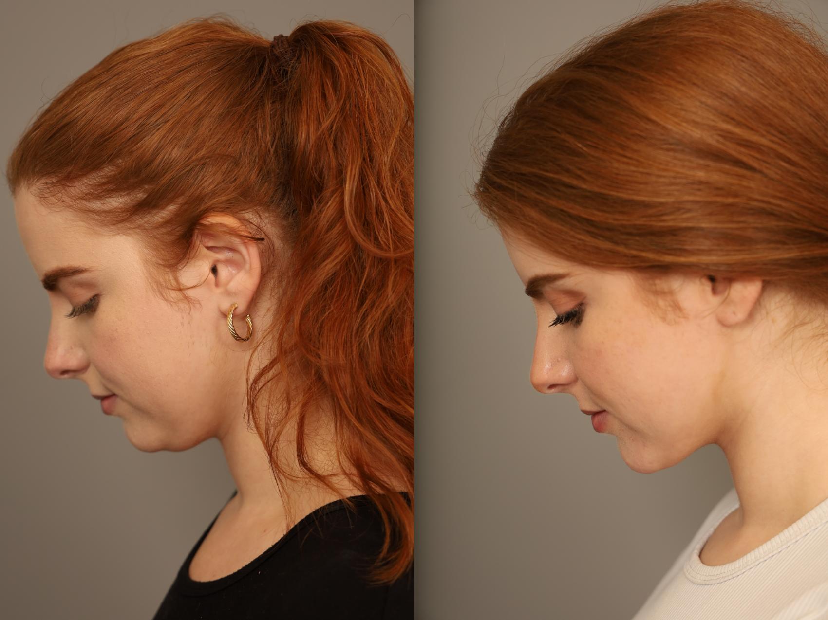 Before & After Neck Liposuction / Chin Liposuction Case 302 Left Side View in New York, NY