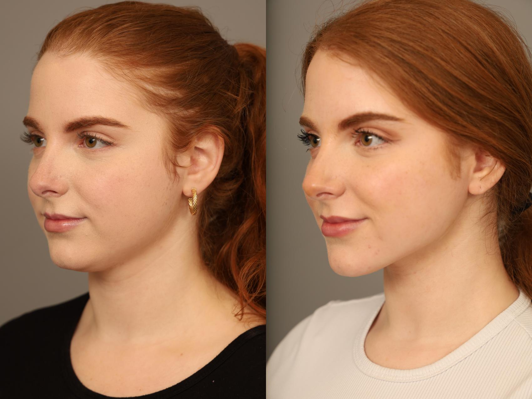 Before & After Neck Liposuction / Chin Liposuction Case 303 Left Side View in New York, NY