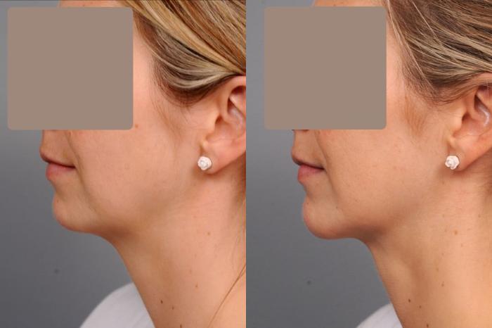 Before & After Neck Liposuction / Chin Liposuction  Case 46 View #3 View in New York, NY