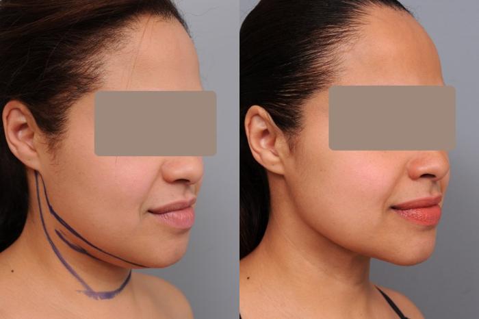 Before & After Neck Liposuction / Chin Liposuction  Case 55 View #2 View in New York, NY