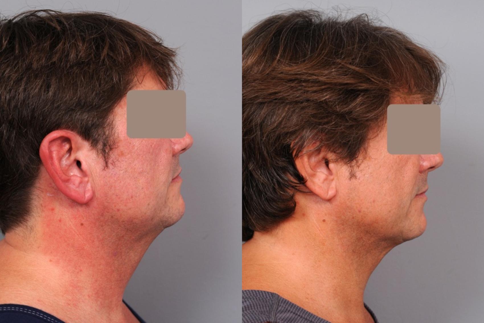 Smartlipo Neck Liposuction Ipl Photofacial In New York