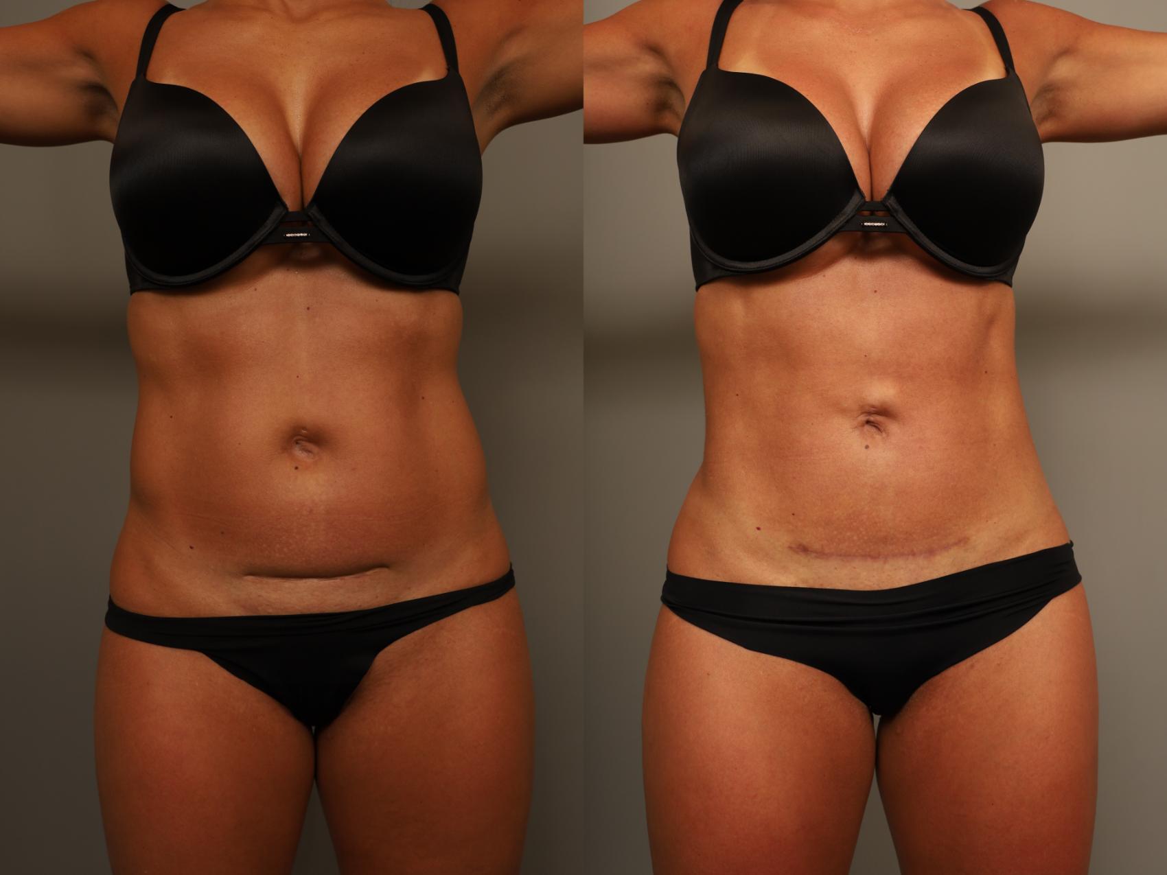 Before & After Scar Revision Case 304 Front View in New York, NY