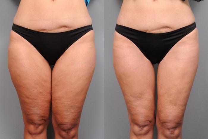 Before & After Thigh Lift Case 121 View #1 View in New York, NY