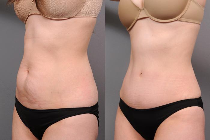 Before & After Tummy Tuck Case 161 View #1 View in New York, NY