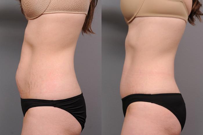Before & After Tummy Tuck Case 161 View #3 View in New York, NY
