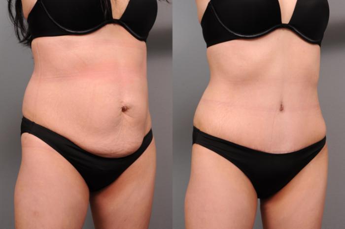 Before & After Tummy Tuck Case 174 View #3 View in New York, NY