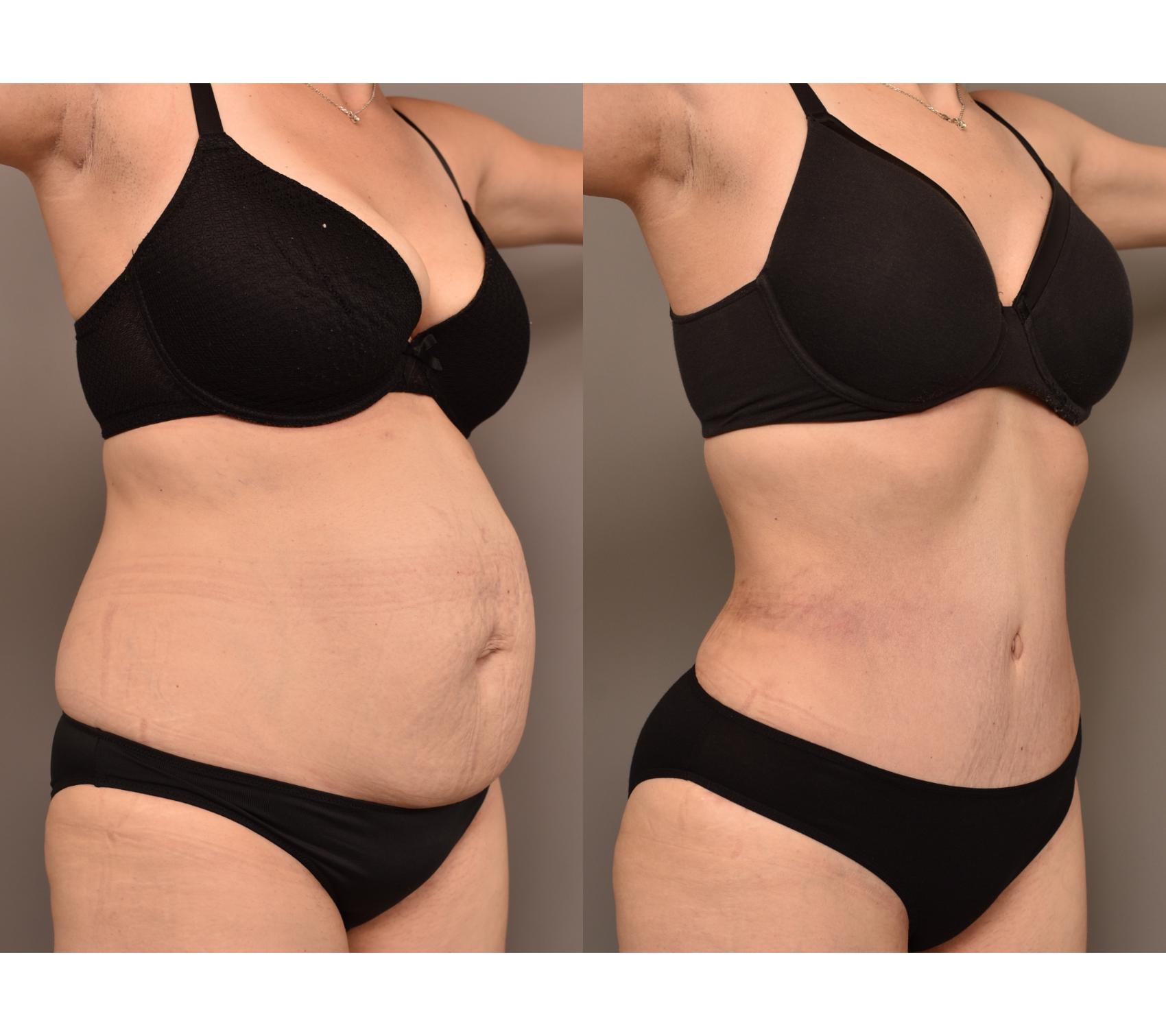 Before & After Tummy Tuck Case 263 Right Oblique View in New York, NY