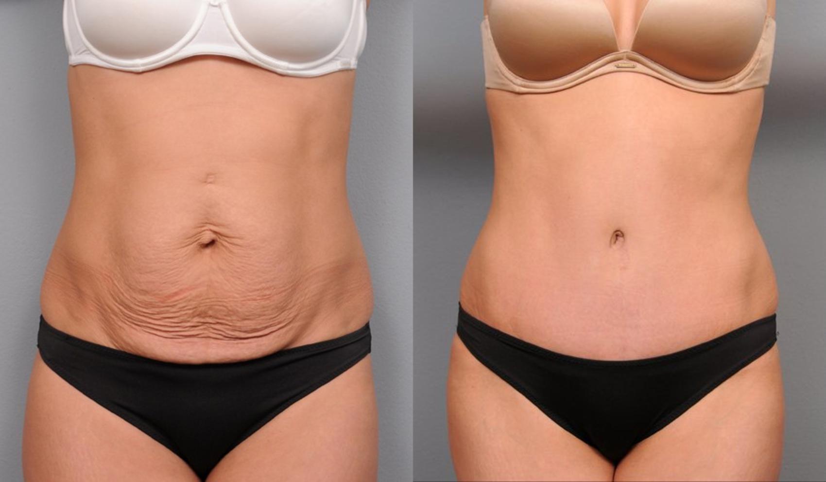 Before & After Tummy Tuck Case 68 View #1 View in New York, NY