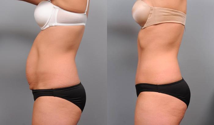 Before & After Tummy Tuck Case 68 View #3 View in New York, NY