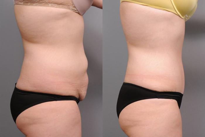 Before & After Tummy Tuck Case 69 View #1 View in New York, NY
