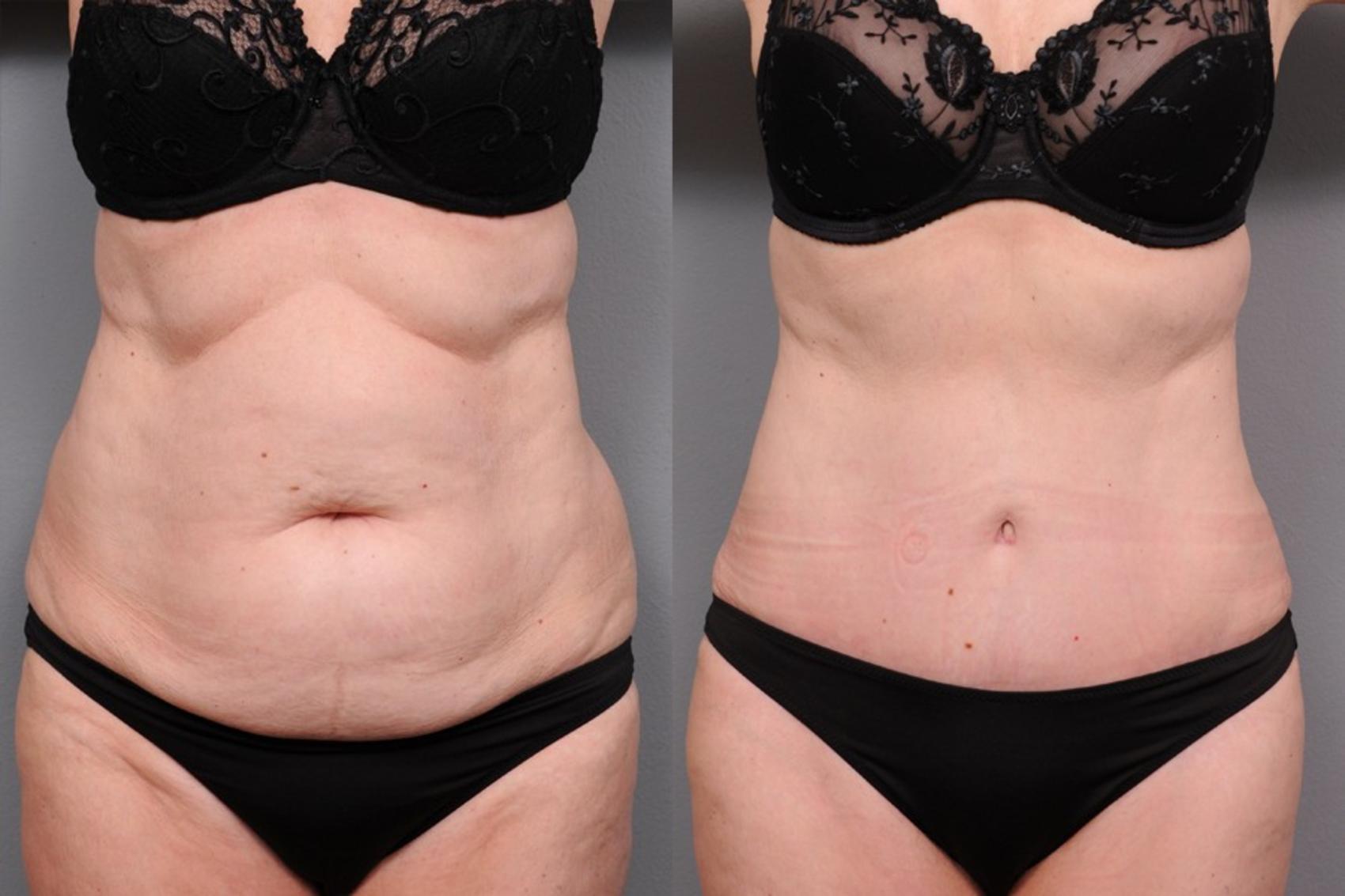Before & After Tummy Tuck Case 71 View #1 View in New York, NY