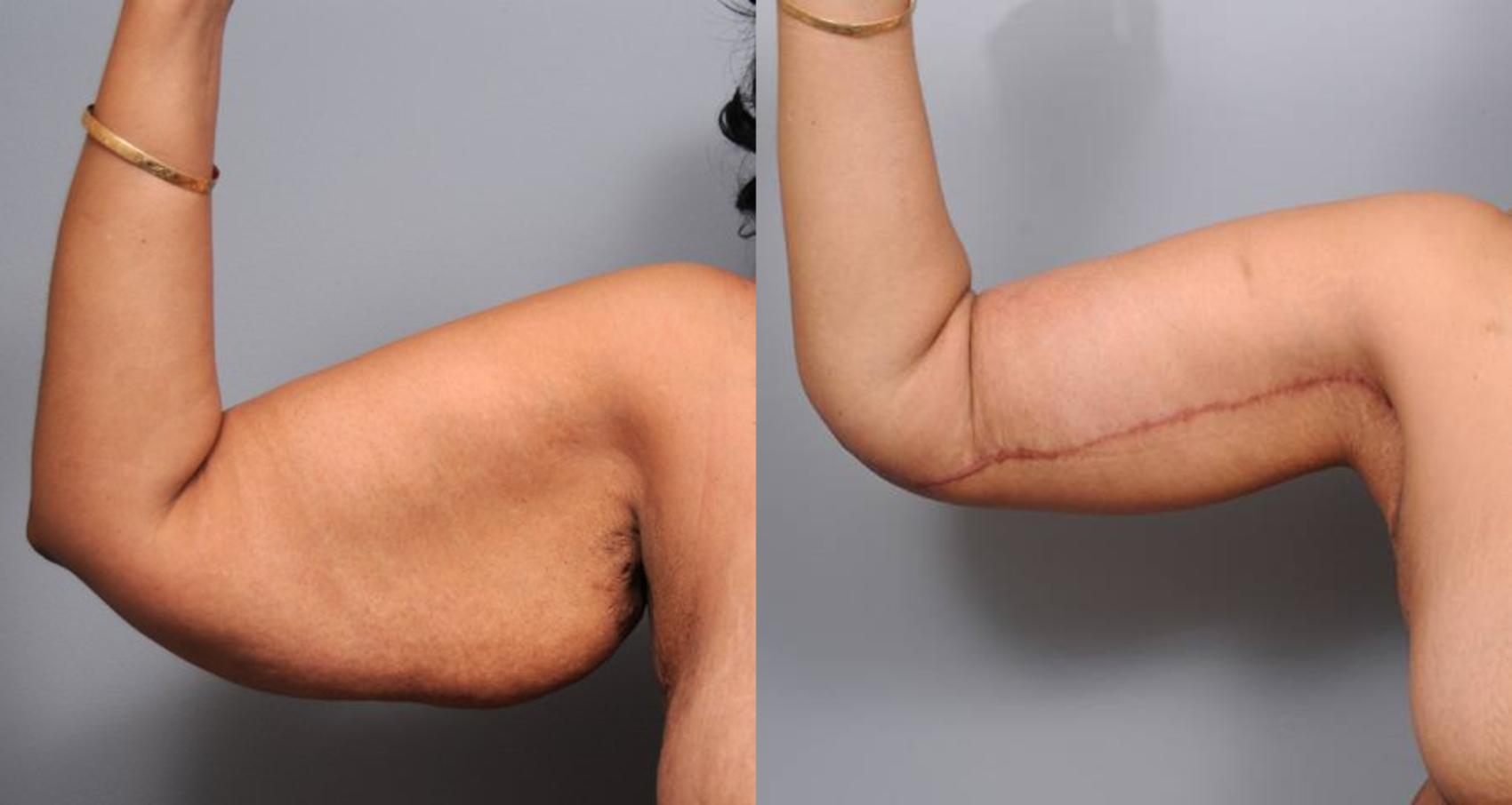 Before & After Arm Lift Case 136 View #2 View in New York, NY