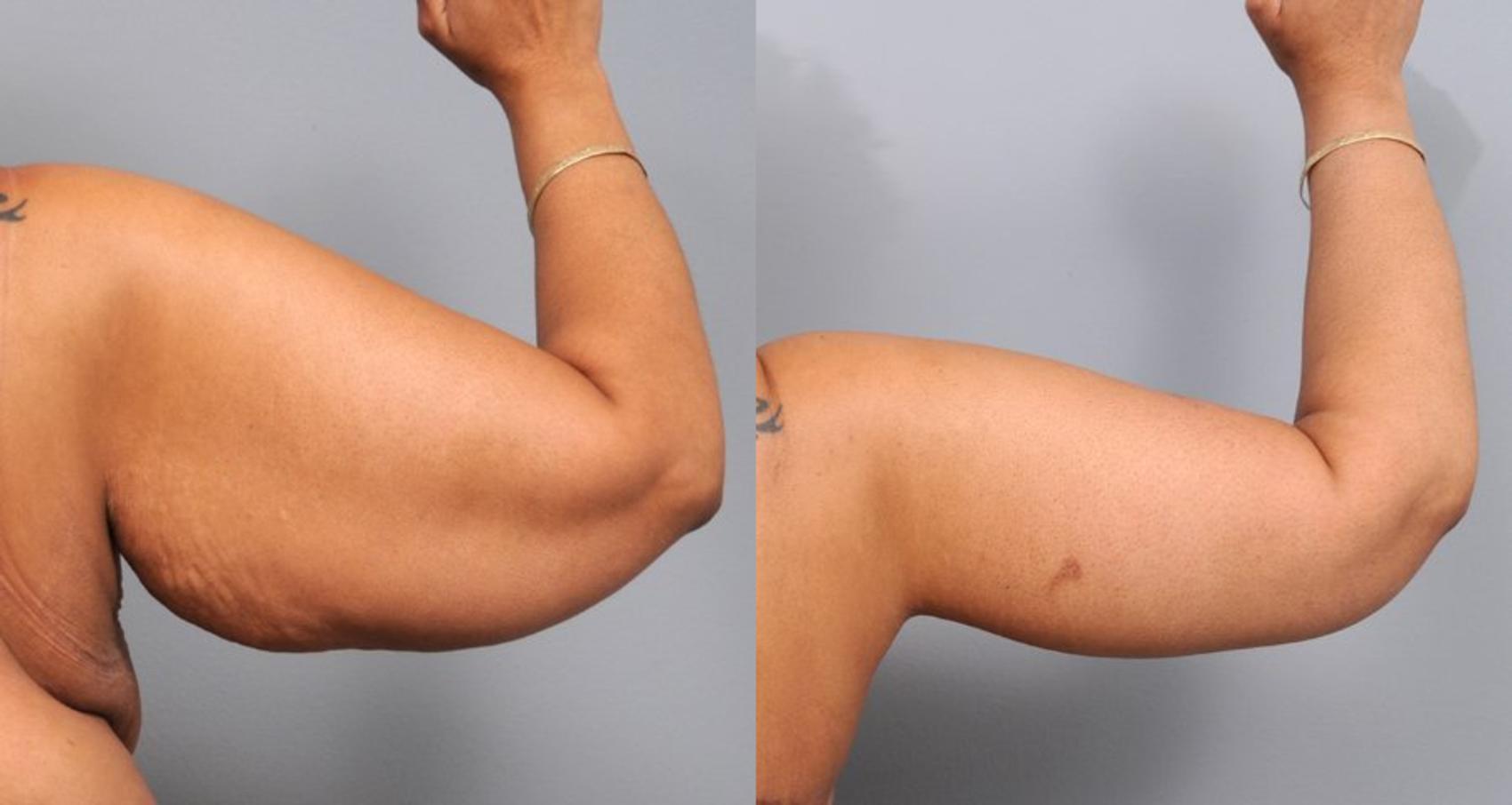 Before & After Arm Lift Case 136 View #3 View in New York, NY