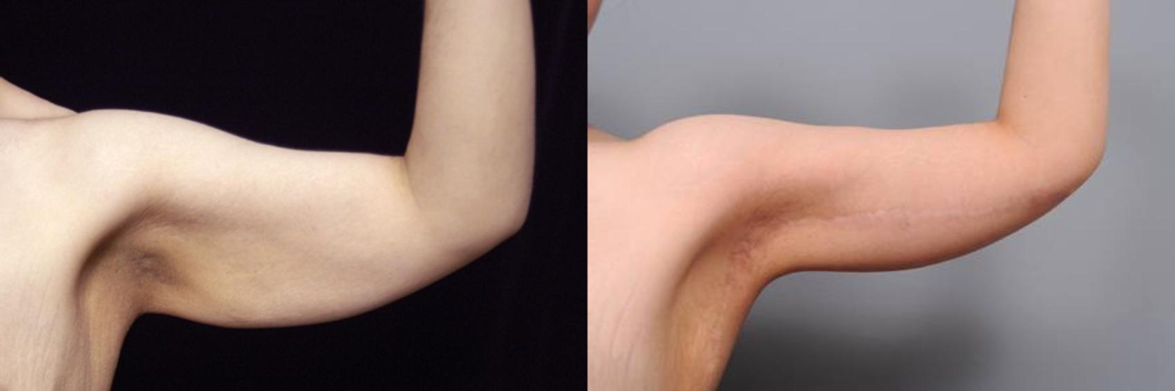 Arm Lift Surgery in NYC & Manhattan  Board-Certified Plastic Surgeon Dr.  Sterry