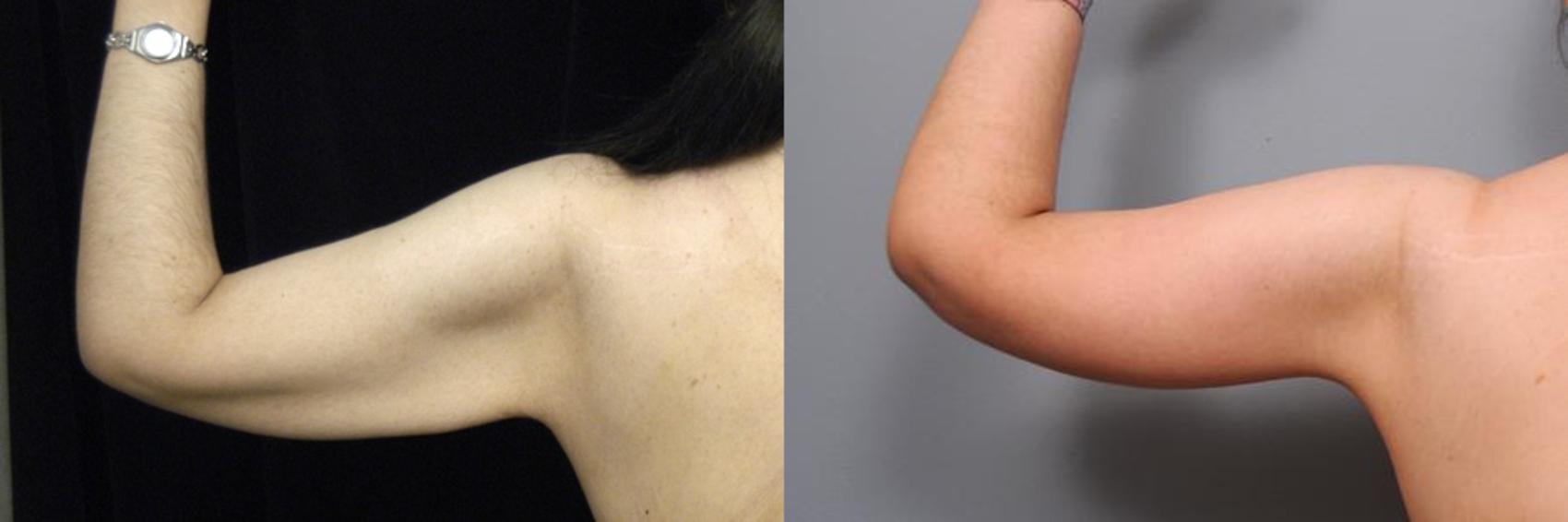 Before & After Arm Lift Case 18 View #2 View in New York, NY