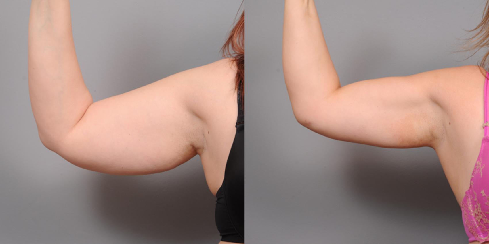 Before & After Arm Liposuction Case 159 View #1 View in New York, NY