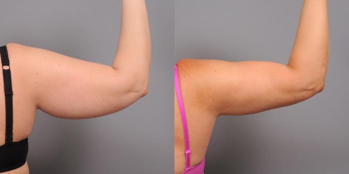 Before & After Arm Liposuction Case 159 View #3 View in New York, NY