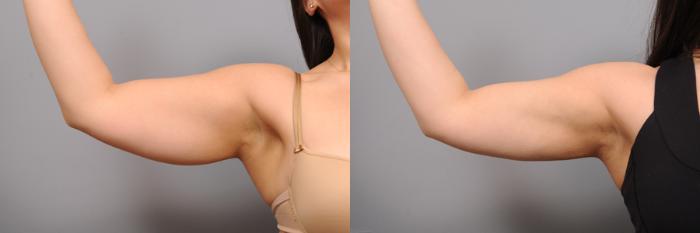 Before & After Arm Liposuction Case 160 View #1 View in New York, NY