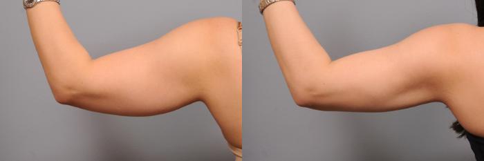 Before & After Arm Liposuction Case 160 View #2 View in New York, NY