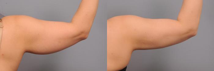 Before & After Arm Liposuction Case 160 View #3 View in New York, NY