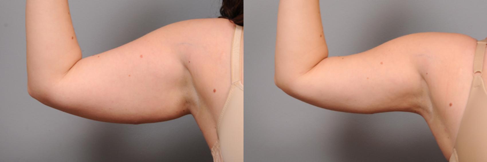Before & After Arm Liposuction Case 162 View #1 View in New York, NY