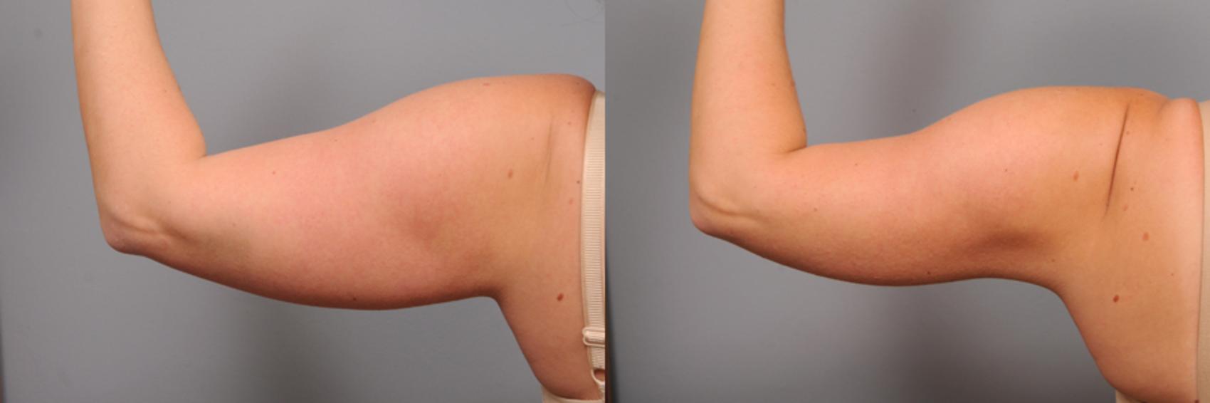 Smartlipo™ Arm Liposuction in New York City