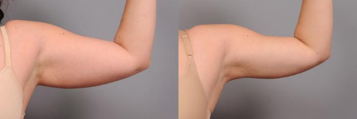 Before & After Arm Liposuction Case 162 View #3 View in New York, NY