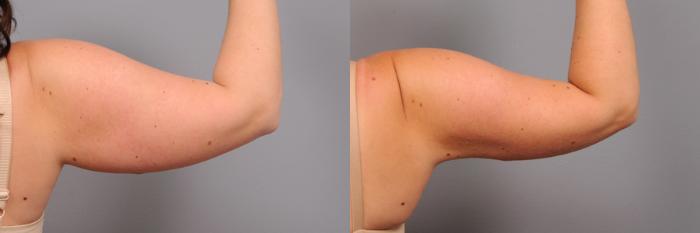 Before & After Arm Liposuction Case 162 View #4 View in New York, NY