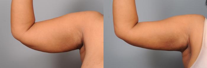Before & After Arm Liposuction Case 163 View #1 View in New York, NY