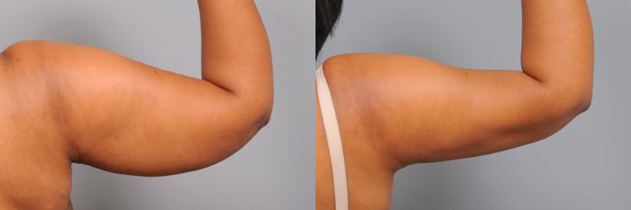 Before & After Arm Liposuction Case 163 View #2 View in New York, NY
