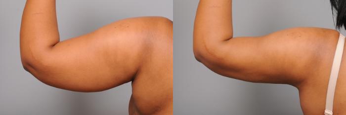 Before & After Arm Liposuction Case 163 View #3 View in New York, NY