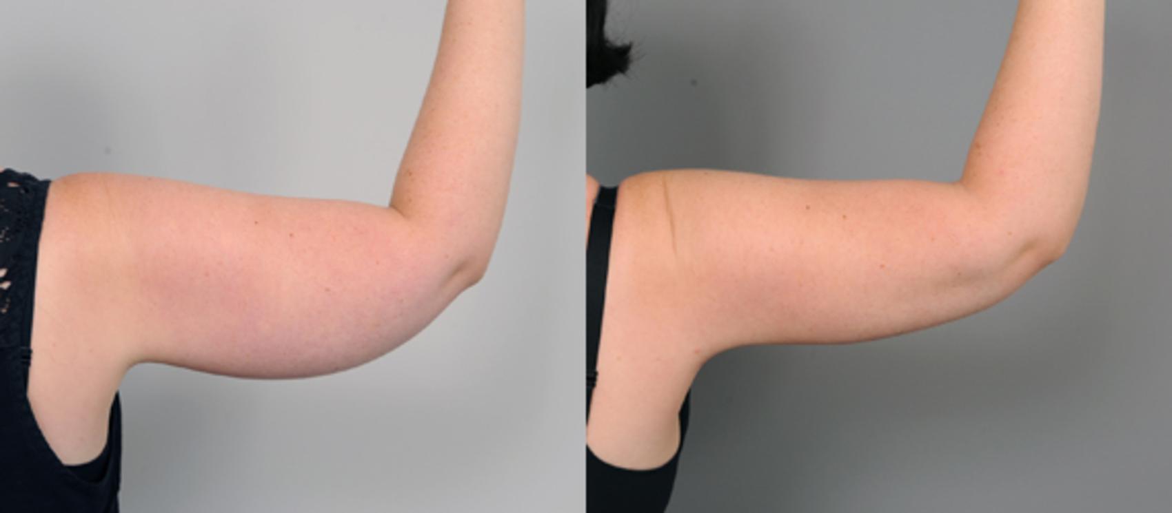 Before & After Arm Liposuction Case 207 View #1 View in New York, NY