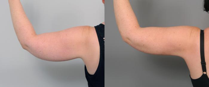 Before & After Arm Liposuction Case 207 View #2 View in New York, NY