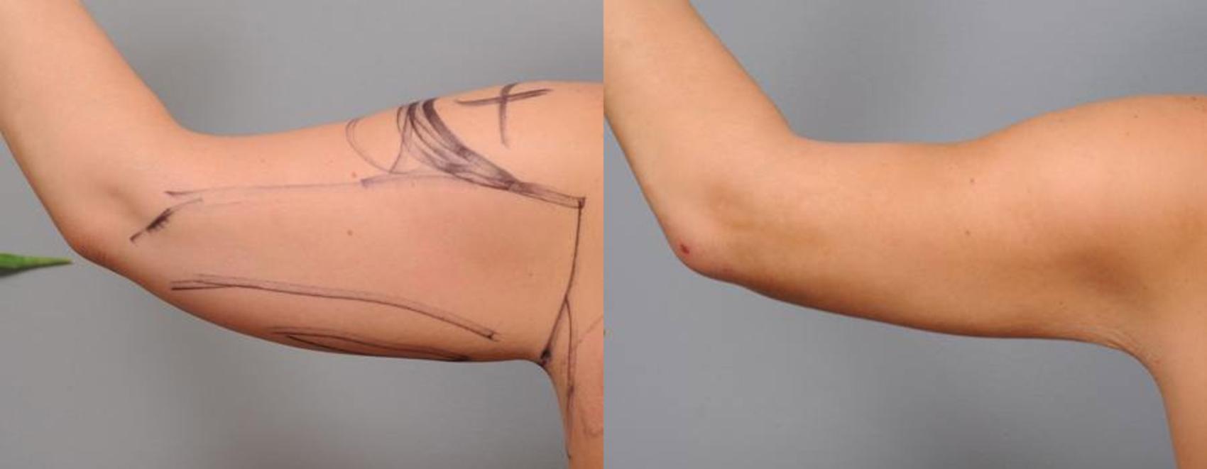 Before & After Arm Liposuction Case 32 View #1 View in New York, NY