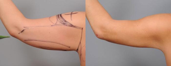 Before & After Liposuction Case 32 View #1 View in New York, NY