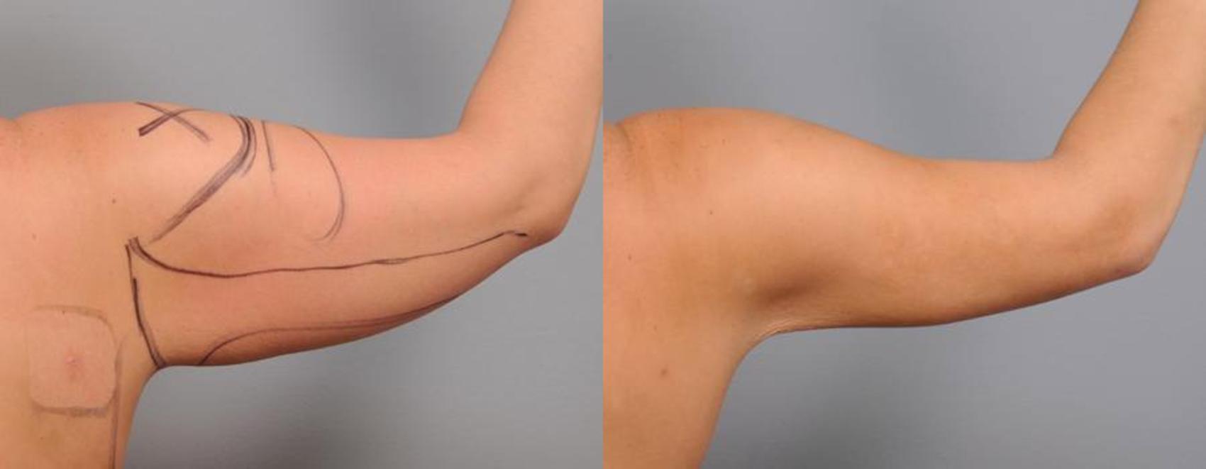 Smart lipo Arms Before & After 