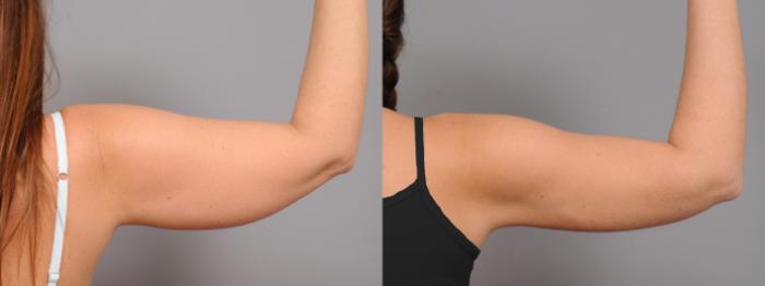 Before & After Arm Liposuction Case 43 View #2 View in New York, NY