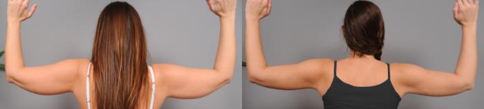 Before & After Liposuction Case 43 View #3 View in New York, NY