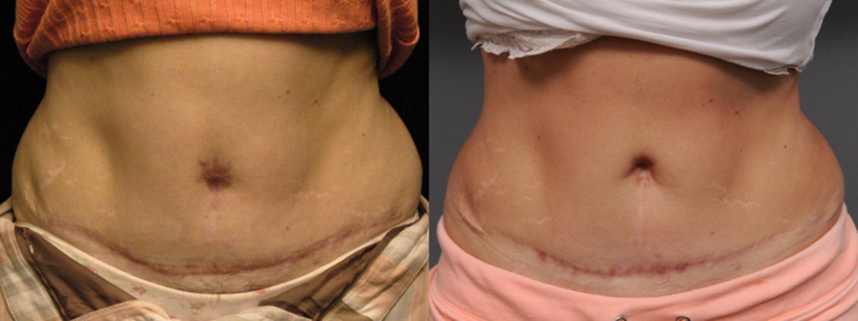 Before & After Belly Button Surgery Case 166 View #1 View in New York, NY