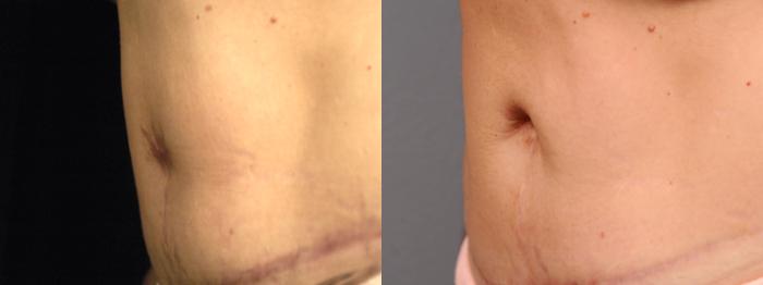 Before & After Belly Button Surgery Case 166 View #2 View in New York, NY