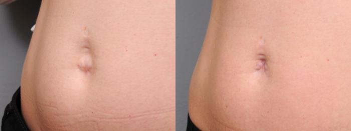 Before & After Belly Button Surgery Case 167 View #2 View in New York, NY
