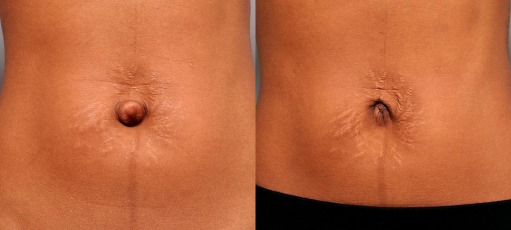 Before & After Belly Button Surgery Case 168 View #1 View in New York, NY