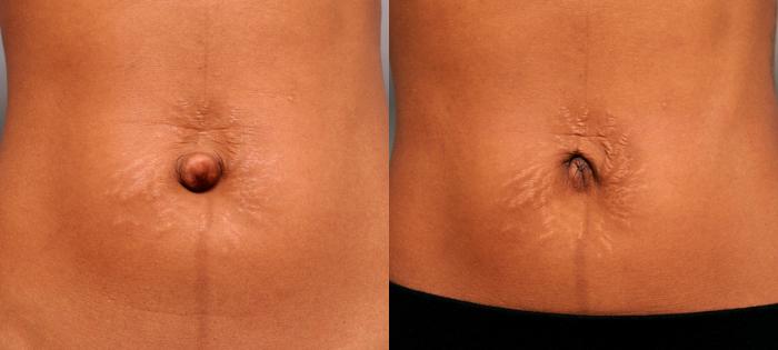 Before & After Belly Button Surgery Case 168 View #1 View in New York, NY