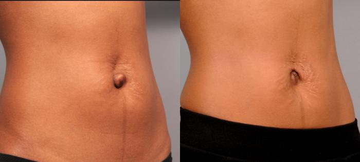 Before & After Belly Button Surgery Case 168 View #2 View in New York, NY