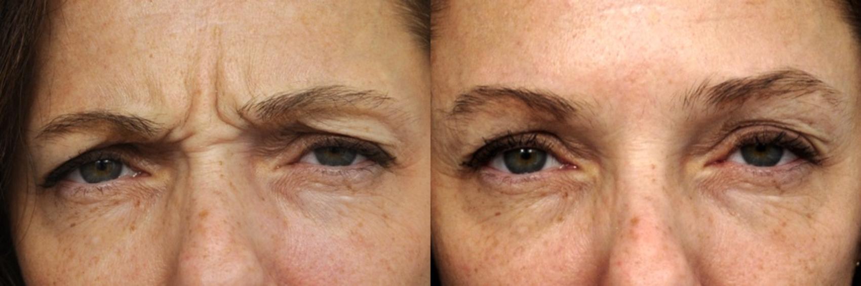 Before & After BOTOX® Cosmetic Case 85 View #1 View in New York, NY